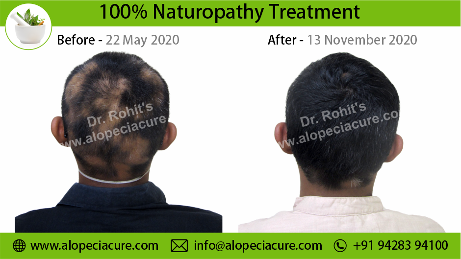 Alopecia Areata Result 3